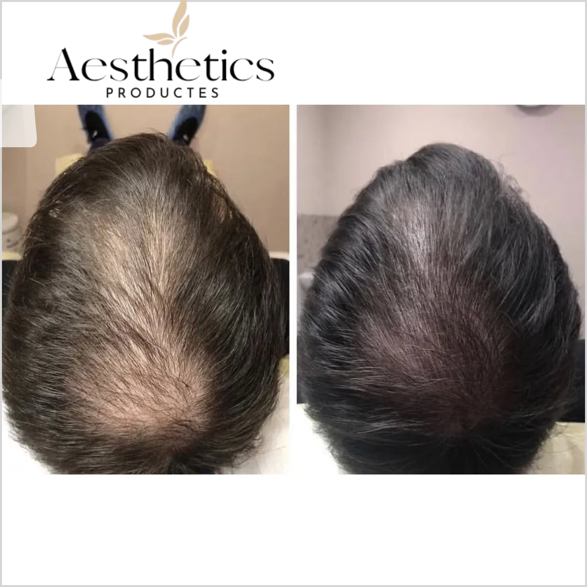 Professional hair loss treatment